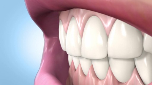 Sonic Blue Teeth Whitening System - image 10 from the video