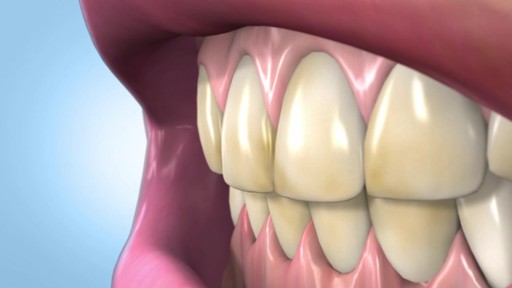 Sonic Blue Teeth Whitening System - image 2 from the video