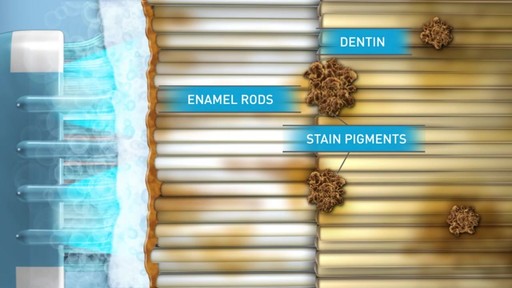 Sonic Blue Teeth Whitening System - image 5 from the video