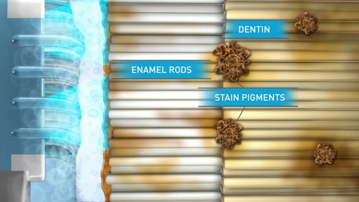 Sonic Blue Teeth Whitening System - image 6 from the video