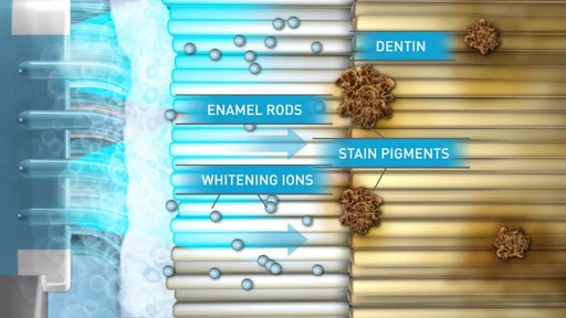 Sonic Blue Teeth Whitening System - image 7 from the video